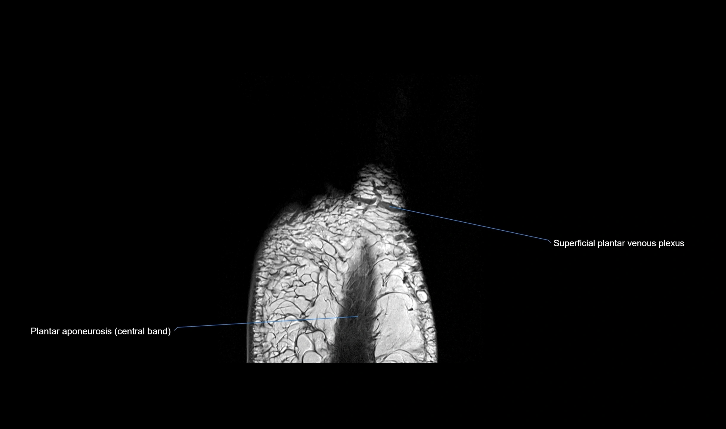 MRI mid foot coronal ligaments cross sectional anatomy 3T  radiology  image-img-00001-00041.webp